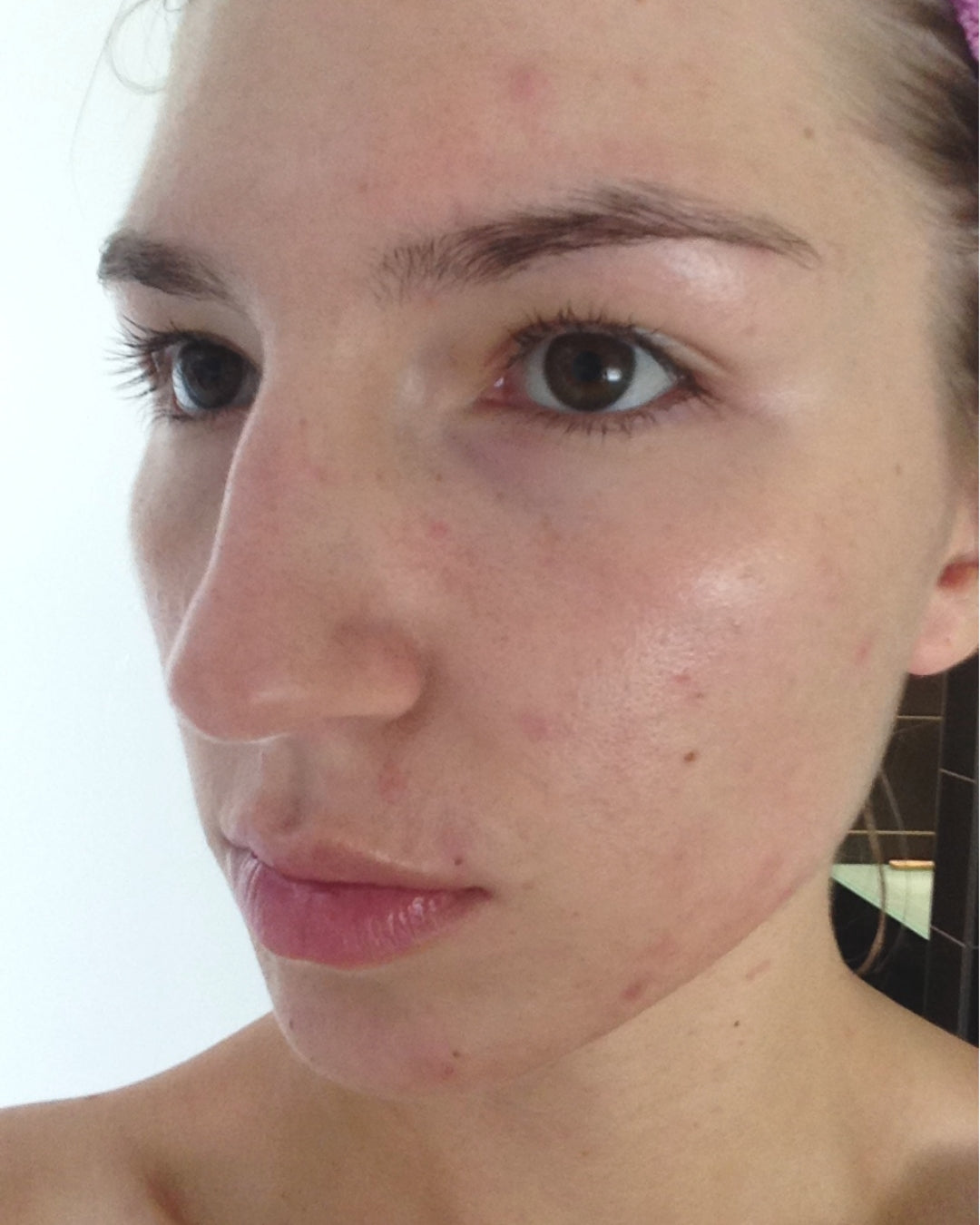 mon visage avec de l'acné des imperfections